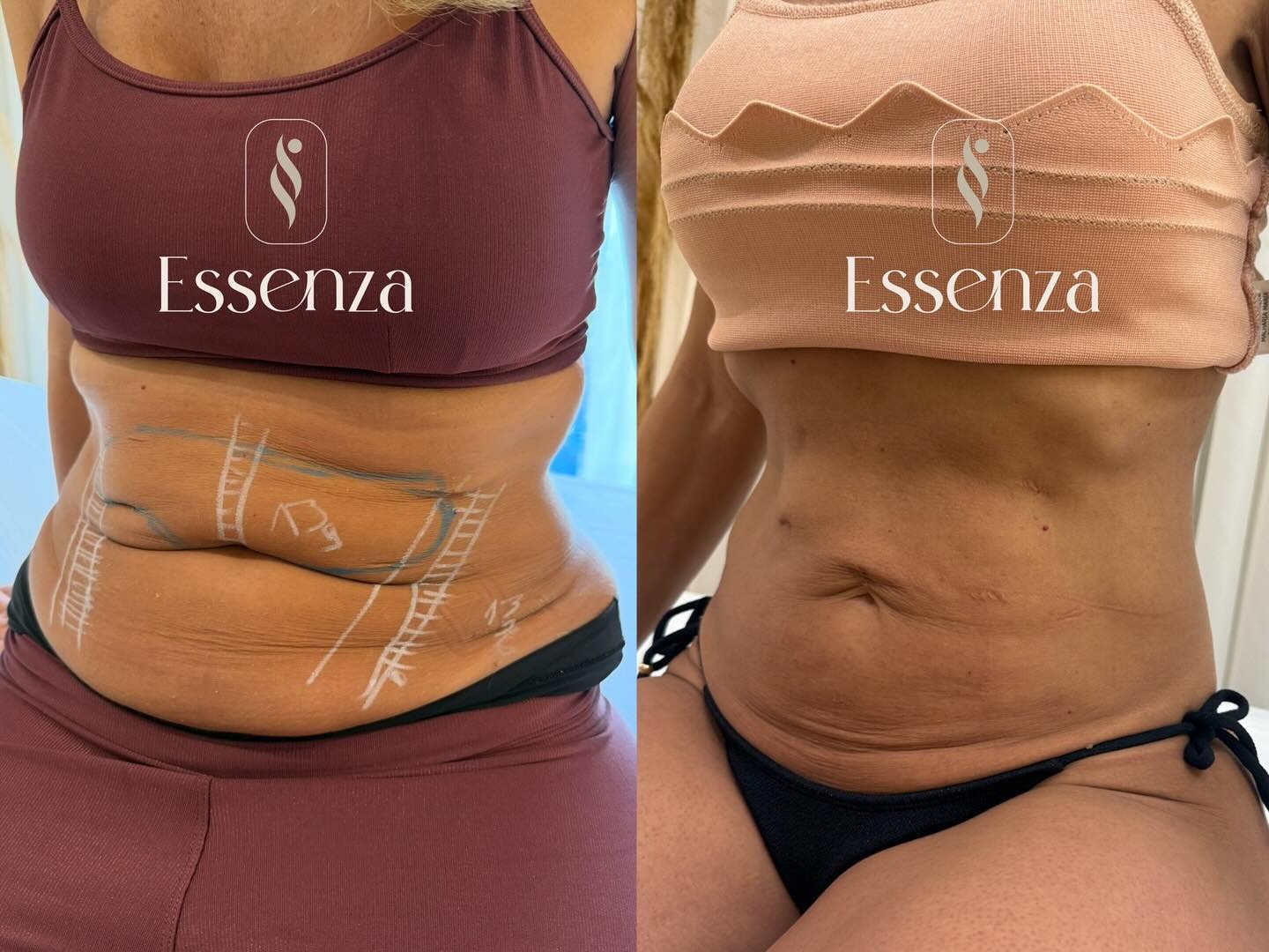 Corporal · Antes e Depois