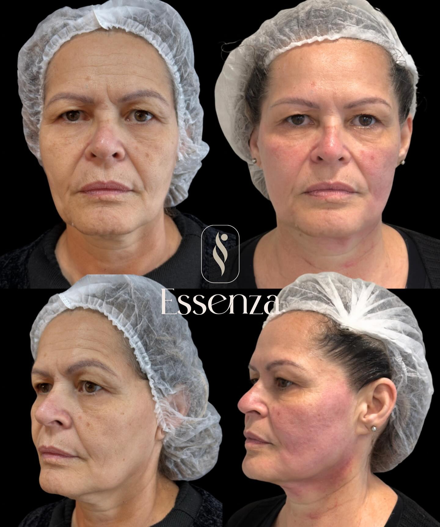 Facial · Antes e Depois